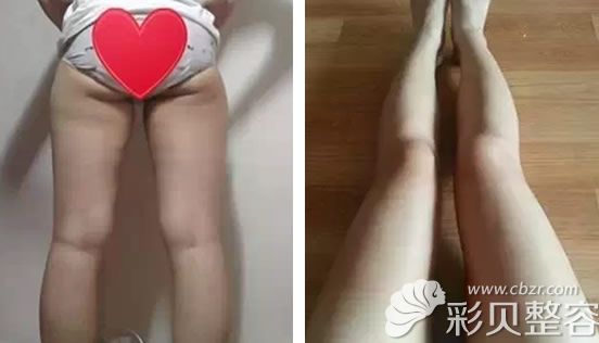 北京米兰柏羽丽都整形小腿吸脂2个月前后效果对比图