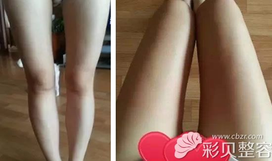吸脂瘦腿第15天