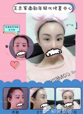 北京王志军做的全面部异物取出术案例效果对比