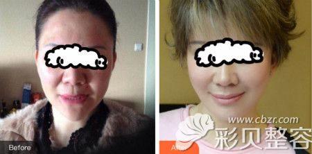 北京奥德丽格王志军为45岁大姐面部除皱案例效果图