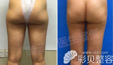 北京八大处顾云鹏做的臀部吸脂案例前后效果对比图