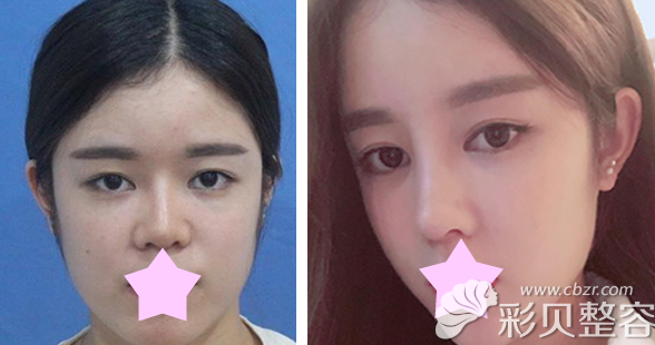 北京米兰柏羽丽都整形刘宁主任做自体软骨隆鼻前后效果对比图