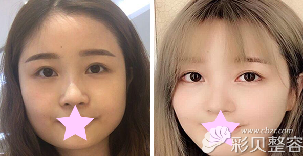 李宁主任做下頜角整形效果案例