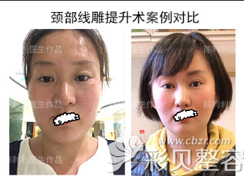 北京奥德丽格陈利利做的面部、颈部线雕提升案例对比效果