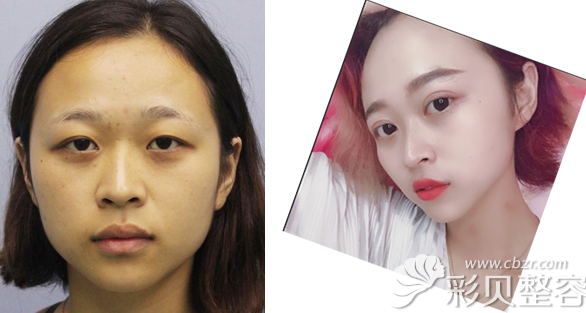 叶瑞红主任韩式全切双眼皮+瘦脸针真实案例图