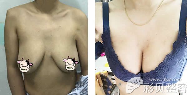 北京韩啸医生假体隆胸+乳房下垂矫正前后对比