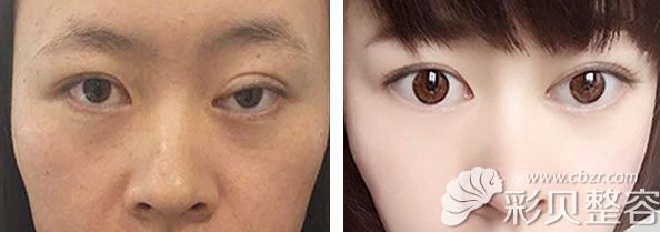 李俊主任修复全切双眼皮效果对比图