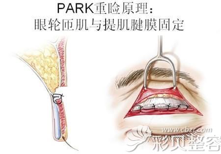 park法重睑术手术原理
