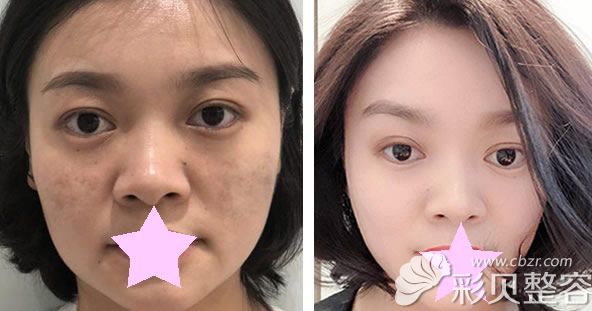 黄喨谊激光祛斑效果对比图