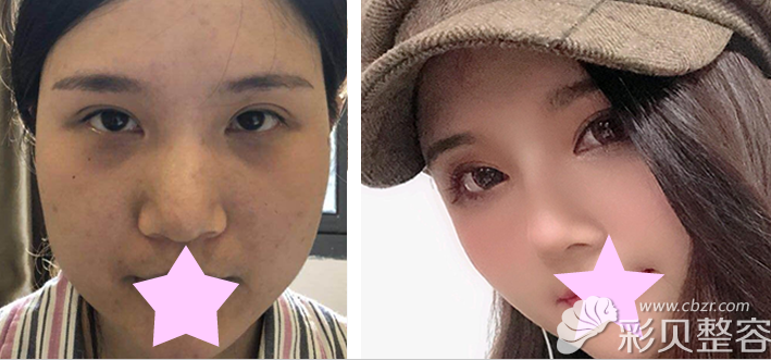 晋超主任假体隆鼻+耳软骨隆鼻效果案例