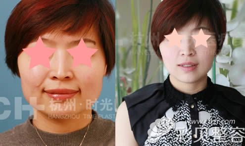 谭琳注射美容瘦脸案例效果对比图