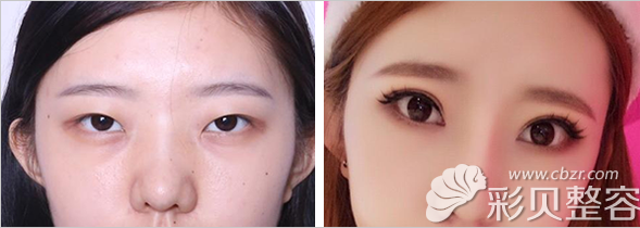 金宝玉眼综合+全切双眼皮效果对比图