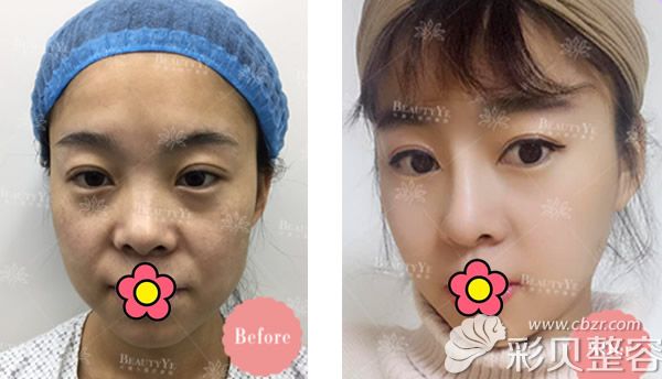 北京叶美人姚明龙达拉斯综合隆鼻+自体脂肪面部填充三个月效果案例