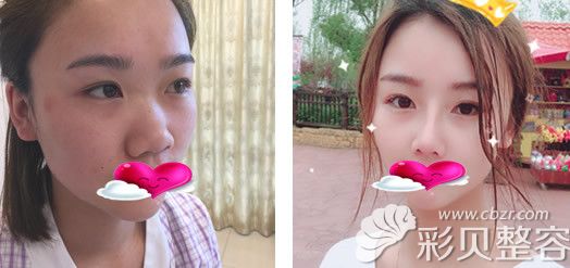 南京连天美整形医院周长兵院长隆鼻术后恢复效果对比图