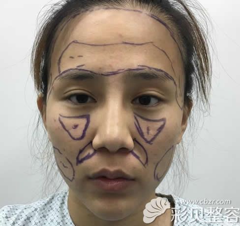 北京叶美人整形院自体脂肪填充和隆鼻前