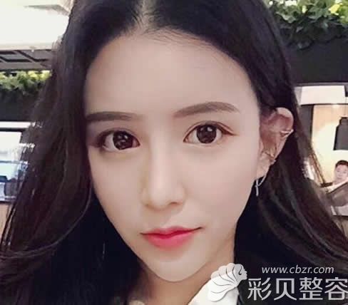 北京叶美人全脸脂肪填充+玻尿酸隆鼻效果案例