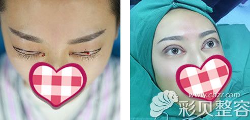 刘医生割双眼皮术后当天对比图