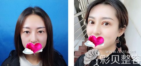 长沙美莱整形医院刘欢医生全切双眼皮术后对比照