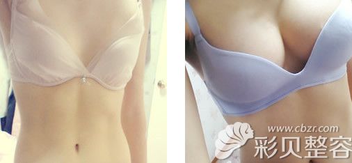 长沙美莱整形医院黄威医生水滴形假体丰胸术后效果对比图 长沙美莱整形医院黄威医生水滴形假体丰胸术后效果对比图