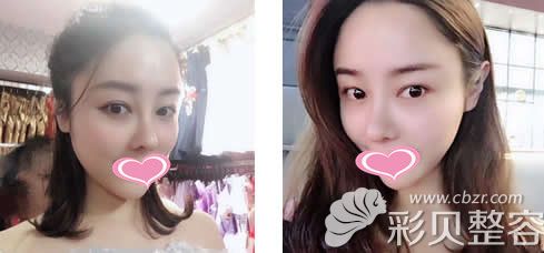 长沙美莱整形医院周文亮医生鼻综合术后90天效果照