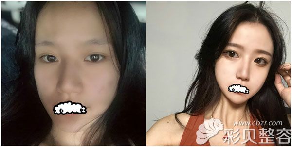 韩国profile改脸型效果前后对比