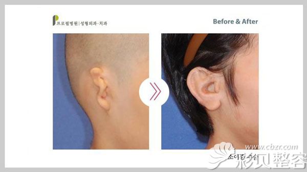 韩国profile整形医院耳朵再造真人案例效果对比