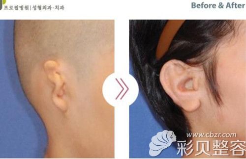 韩国郑在皓做的耳朵畸形再造手术对比图