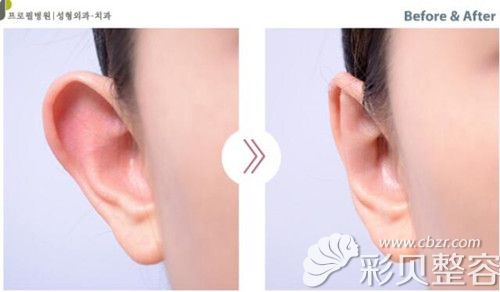 韩国Profile李好基展示招风耳案例图 韩国Profile李好基展示招风耳案例图