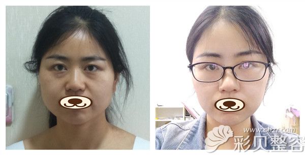 上海德媛医疗美容门诊徐劲松瘦脸针术后5天效果对比照