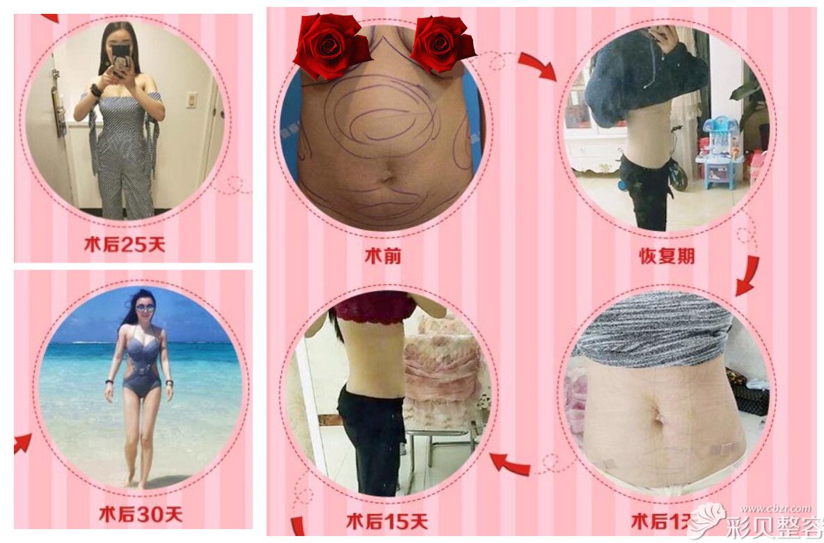 北京知音整形赵禹翔腰腹吸脂减肥案例图