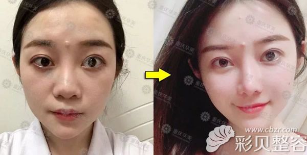 重庆华美何春涛假体隆鼻效果案例