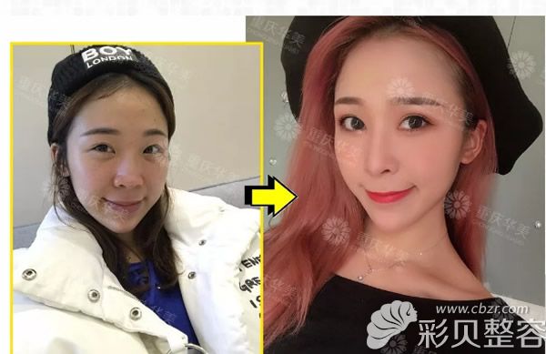 重庆华美鼻综合隆鼻效果前后效果对比图
