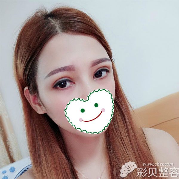 瞧我找广州曙光王娟割双眼皮6mm一年后照片效果还很明显