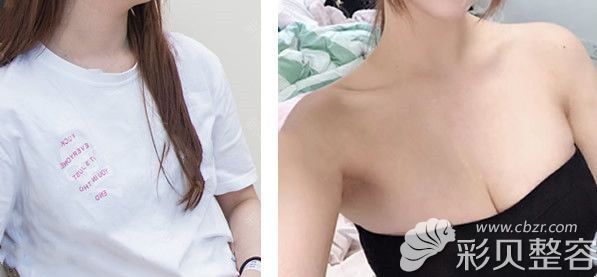 广州美莱李高峰硅胶假体隆胸三个月效果案例
