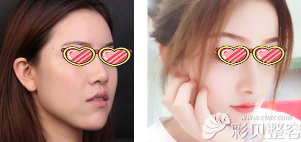 深圳美莱玻尿酸隆鼻前后效果对比案例