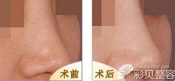 自体肋软骨垫鼻尖前后效果对比