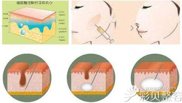 玻尿酸填充泪沟有凸起的鼓包吗