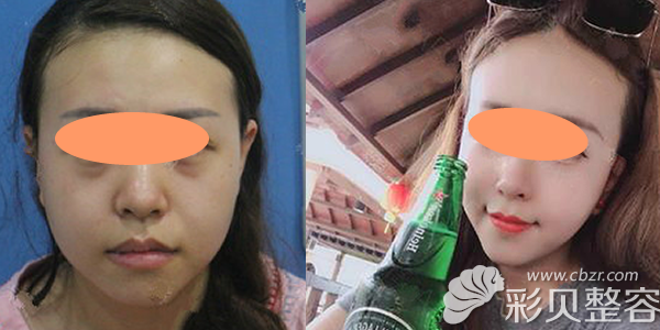 杭州格莱美彭涛面部吸脂瘦脸案例效果对比
