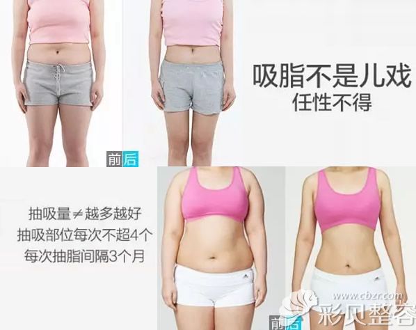 北京海医悦美大腿吸脂和腰腹吸脂案例