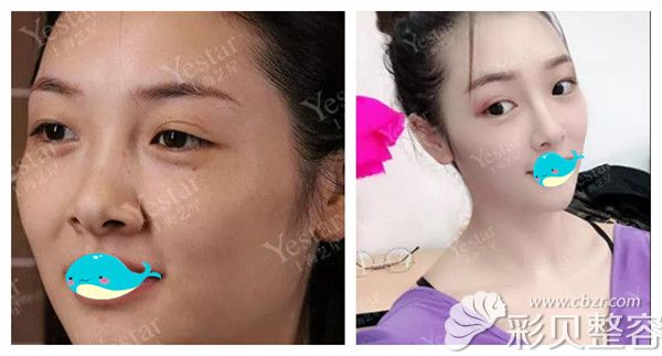 上海艺星皮秒三维闪电祛斑术后真实对比效果展示