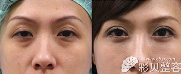 海南韩美玻尿酸去黑眼圈效果案例