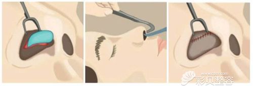 隆鼻手术原理