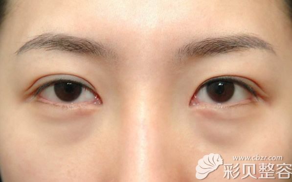 玻尿酸去黑眼圈却出现了眼袋是怎么回事