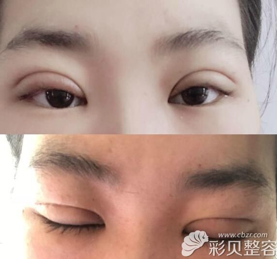 肿泡眼割双眼皮7mm一个月恢复效果图