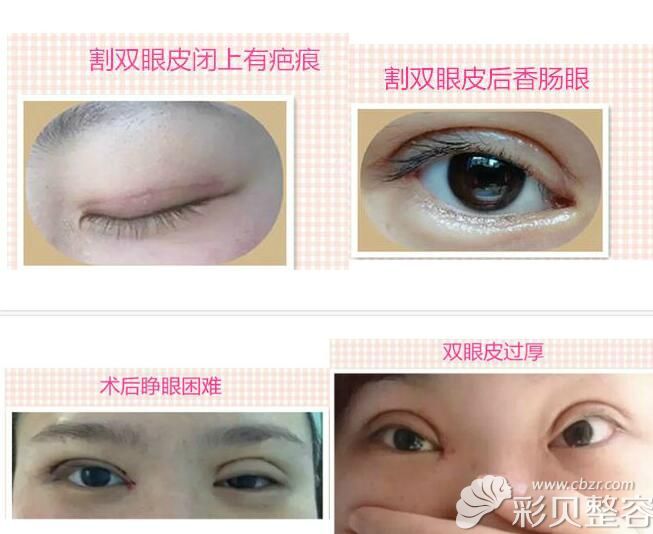 割双眼皮失败效果展示