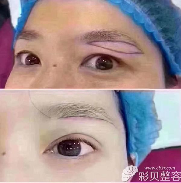三门峡华美整形提眉术前后对比