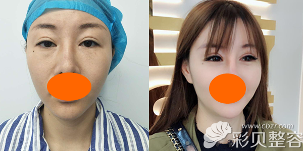 全切双眼皮改善眼皮一款一窄效果对比图分享 全切双眼皮改善眼皮一款一窄效果对比图分享