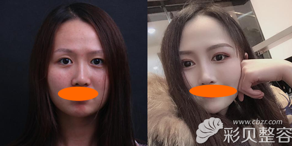 上眼睑提肌手术改善大小眼案例效果图展示 上眼睑提肌手术改善大小眼案例效果图展示