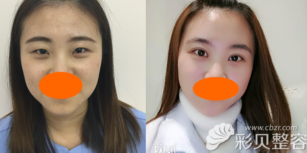 开内眼角+割双眼皮改善眼睛不对称案例效果图展示 开内眼角+割双眼皮改善眼睛不对称案例效果图展示