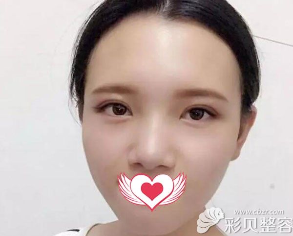 双眼皮手术20天恢复效果图